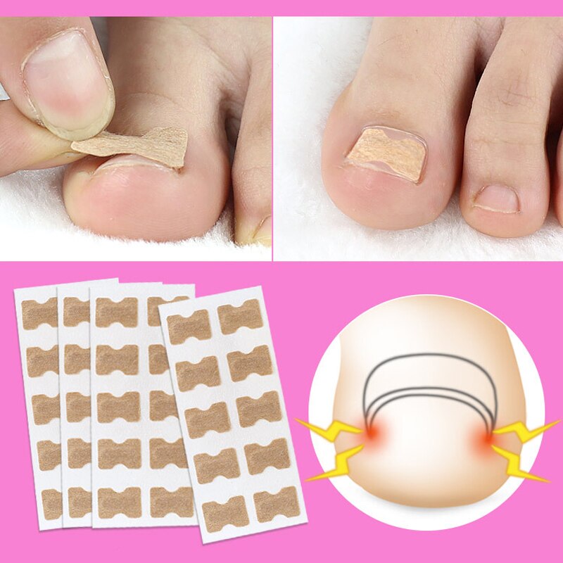 Ingrown Toenail Corrector Stickers